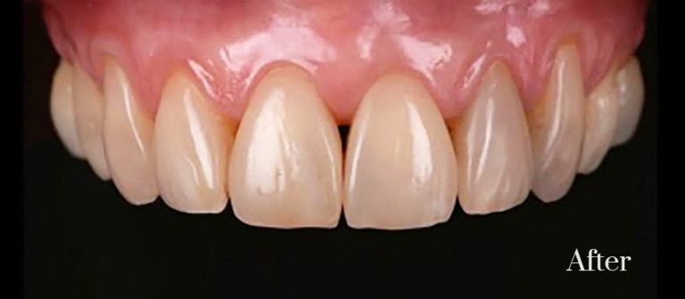 Composite Veneers Sydney And Composite Veneer Cost Smile Concepts