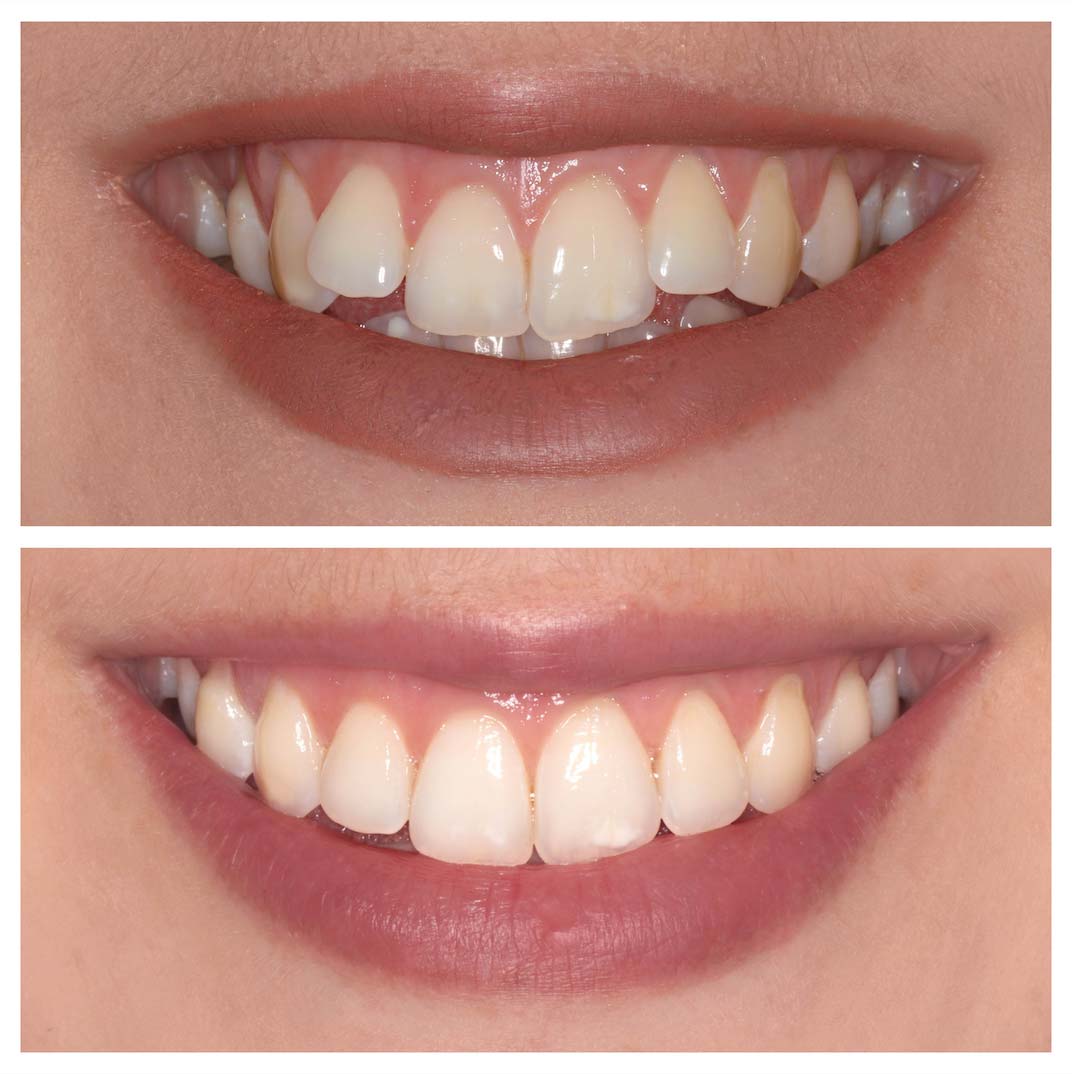 Misaligned & Crowded Teeth - Teeth Straightening | Smile Concepts