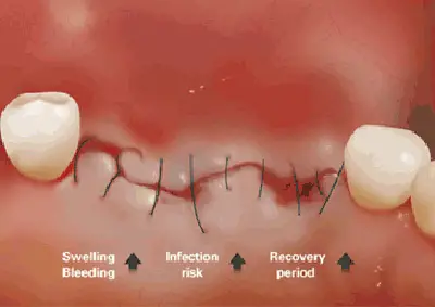 traditional dental implant procedure