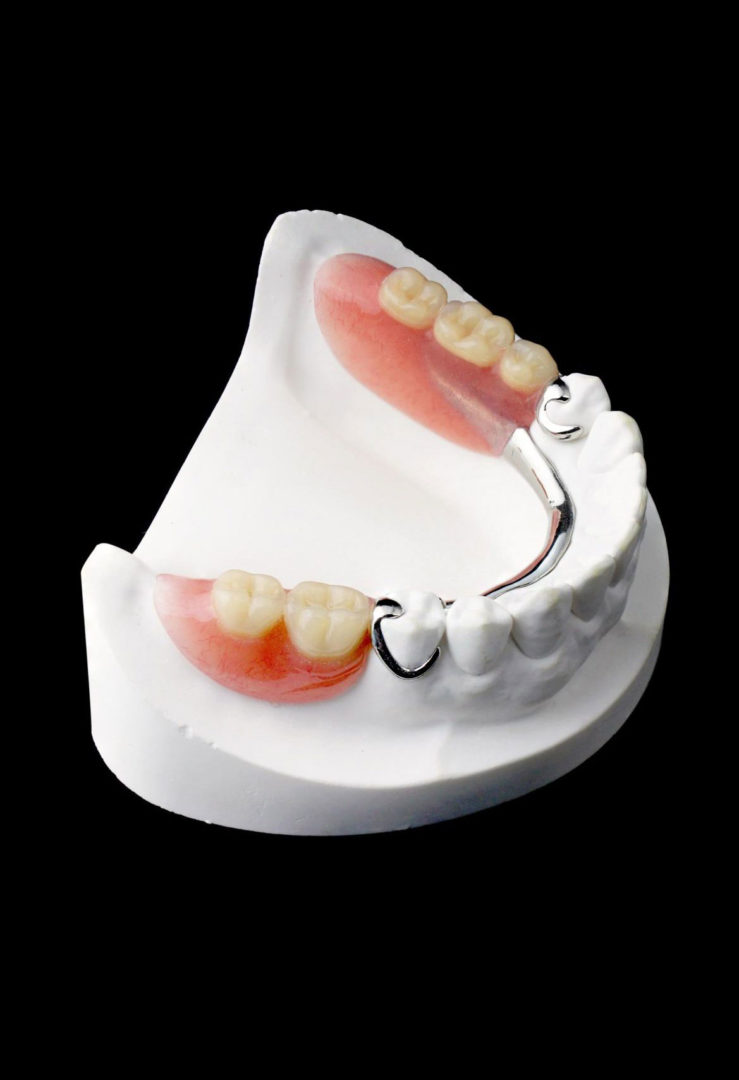 denture implants