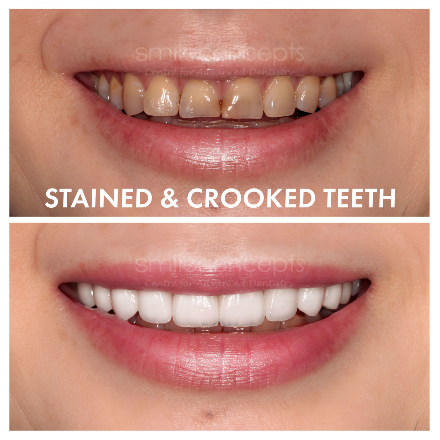 How Many Porcelain Veneers Do I Need? | Smile Concepts